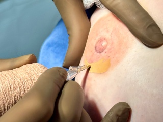 A patient receives a 3D nipple and areolar tattoo on their newly reconstructed breast.
