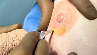 A patient receives a 3D nipple and areolar tattoo on their newly reconstructed breast.