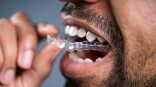 Man puts orthodontic teeth straightening mouthguard in mouth.
