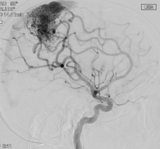 A scan showing the arteriovenous malformation – or AVM – in Kian Ruid’s brain.