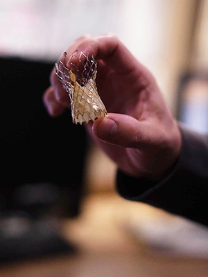 Hands hold an aortic valve for transcatheter aortic valve replacement (TAVR) procedure at UVM Medical Center.