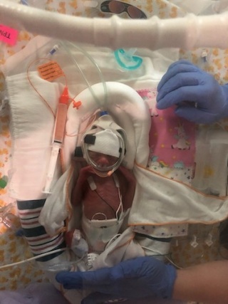 Heidi Fitzhugh, a tiny baby born prematurely, sleeps in the UVM Children Hospital NICU bed wrapped in tubes and blankets.