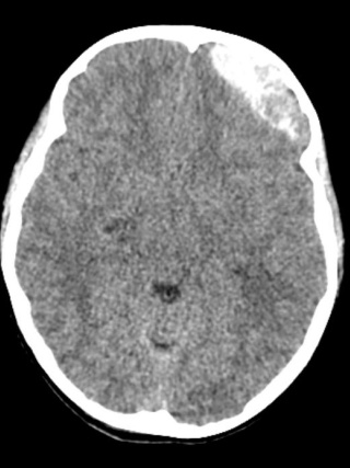 CT scan of an acute epidural hematoma in pediatric patient Eliza Andrews.